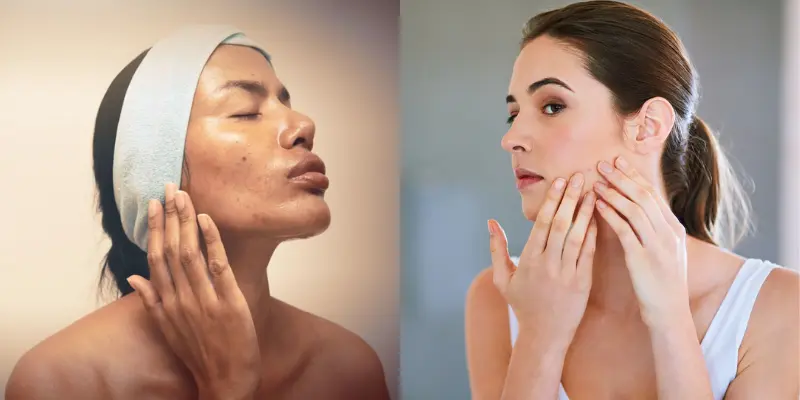 Understanding Sensitive, Oily Skin