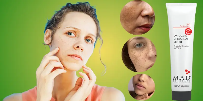 What is Dull Skin?